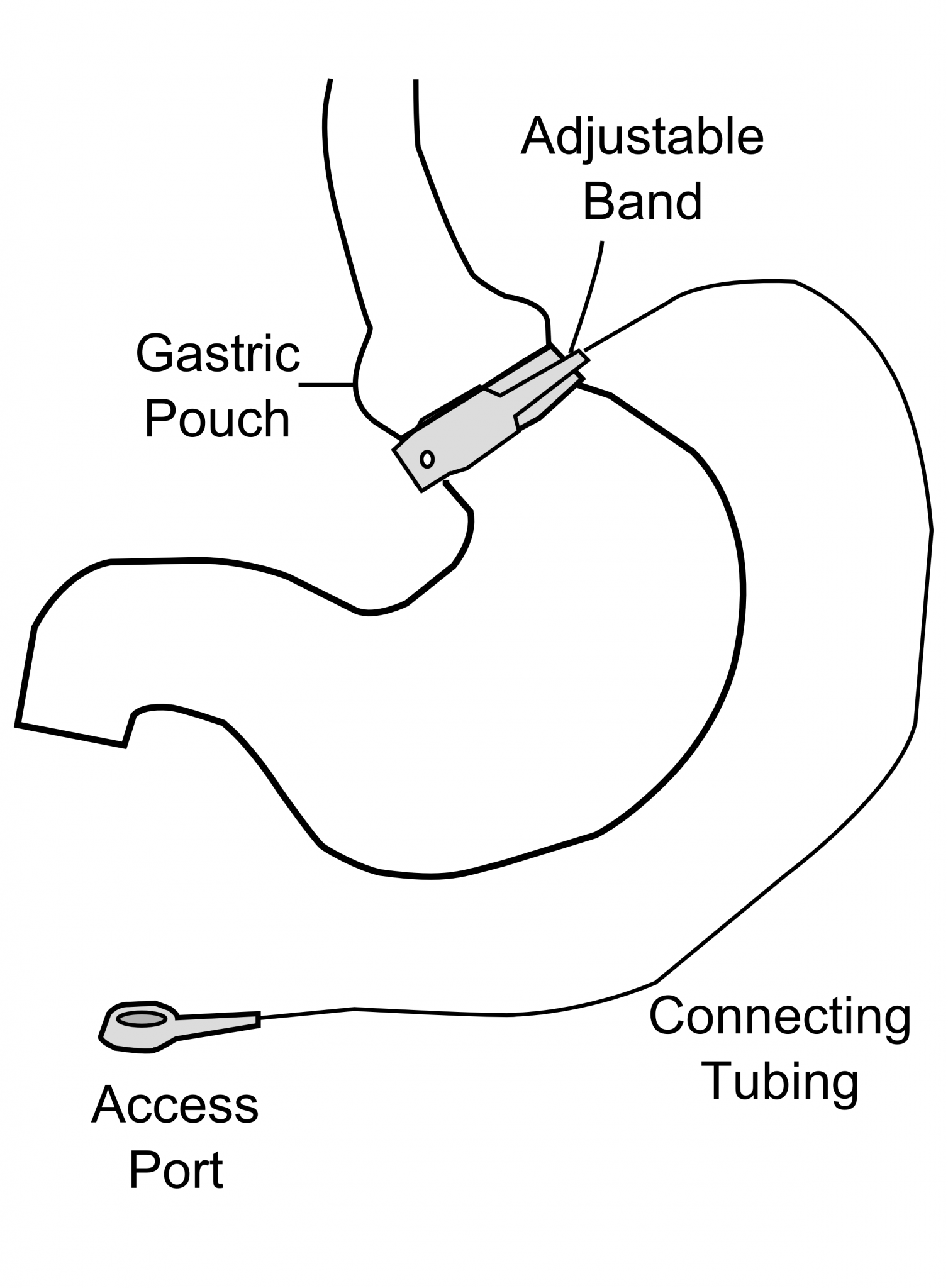 Type of Operations BariatricSurgeryInfo